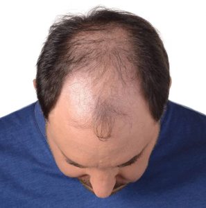 how-to-reduce-hair-loss-in-men